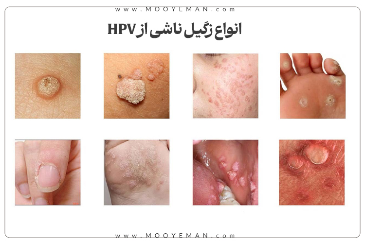 انواع زگیل ناشی از HPV