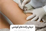 زایده گوشتی روی پوست را سه سوته محو کن